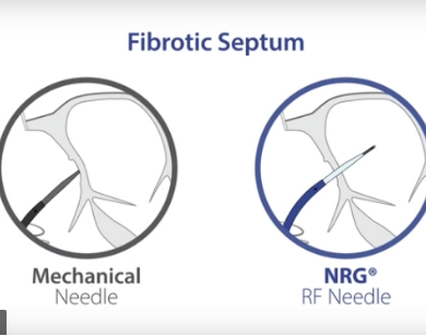 NRG RF Needle Animation